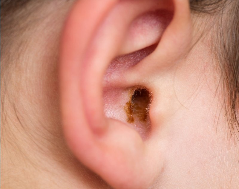 Ear Problems in Children